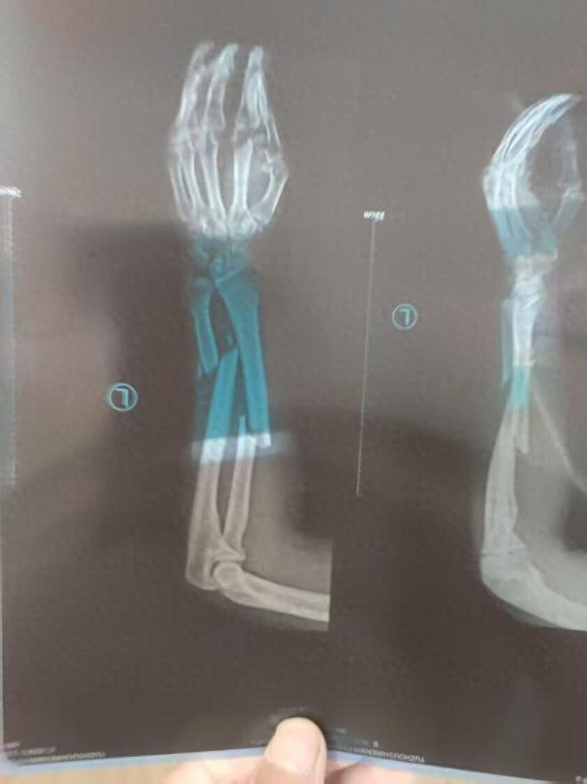 “男子被钻机拧断胳膊难获37万工伤补助金”：相关方支付10万元承诺余款分期结清